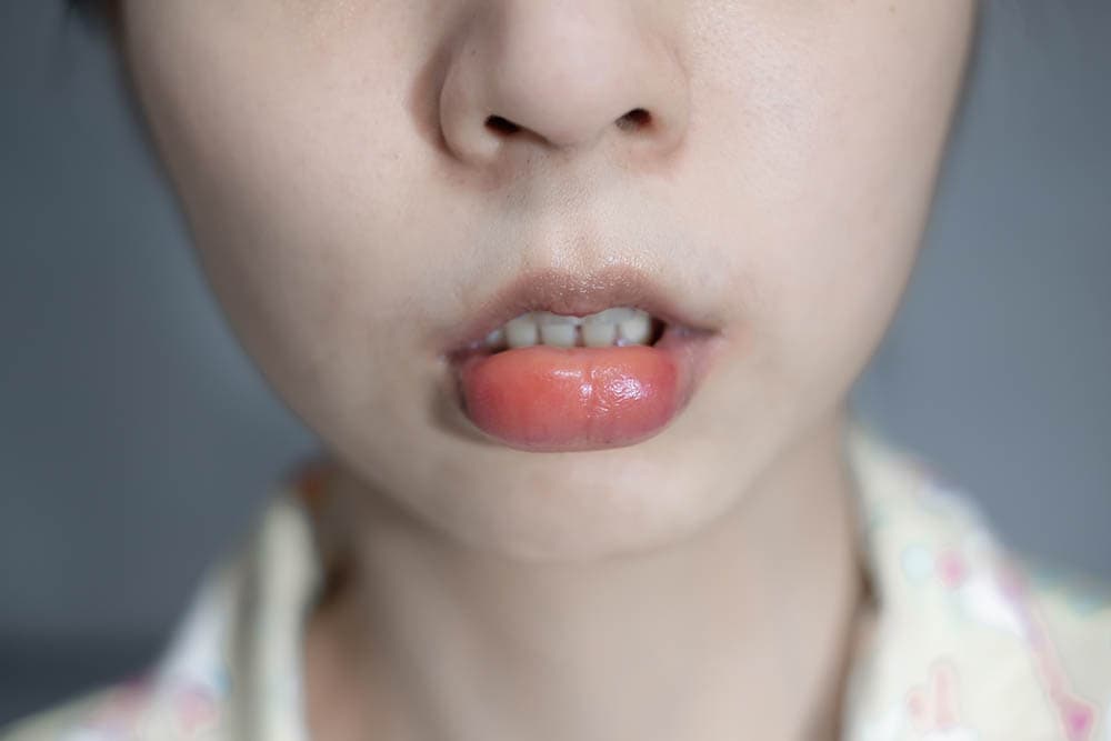 close up woman with swollen lip