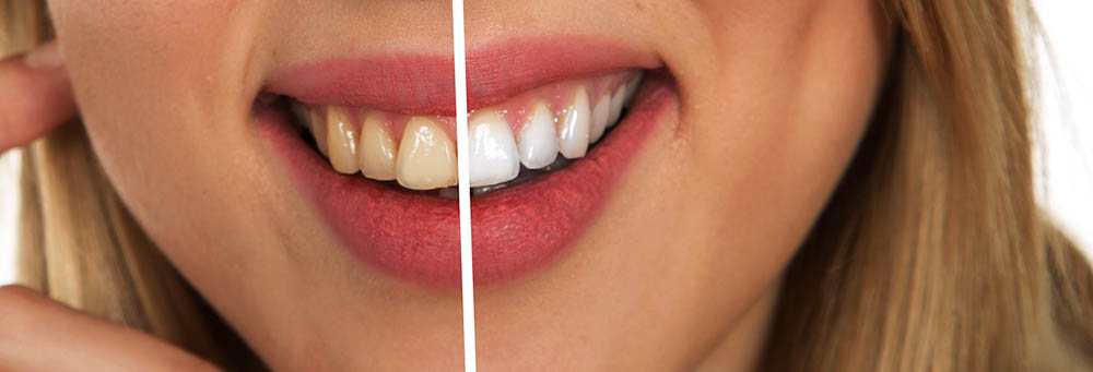 stained teeth difference
