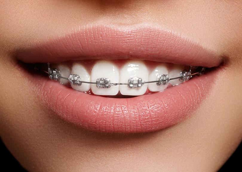 makro białe zęby z aparatami ortodontycznymi